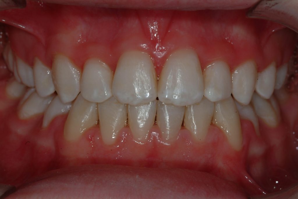 Metal Stainless Steel Braces Bank Cottage Dental Dentist in