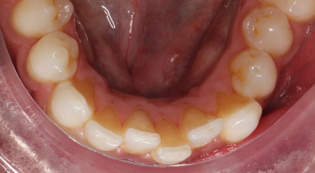 Mild Tooth Movement Relapse Bank Cottage Dental Dentist in