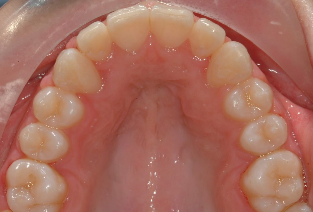 Unerupted Teeth - Bank Cottage Dental | Dentist in Thornbury, Bristol